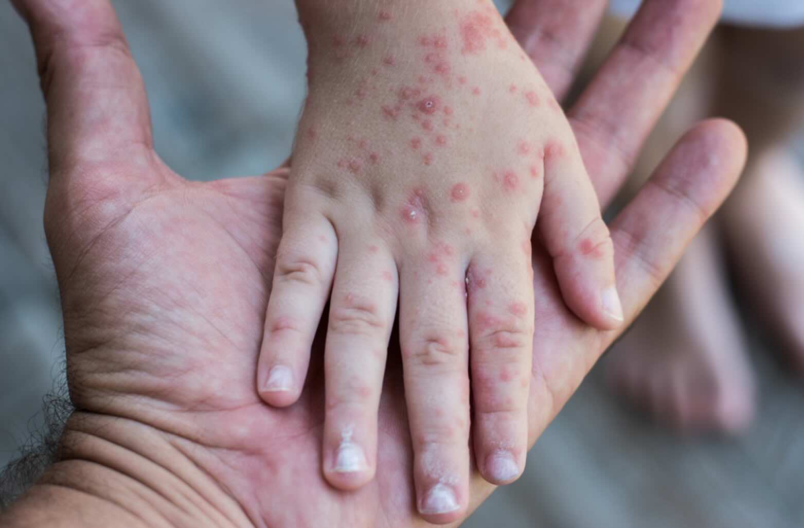 Vera, a la cabeza de casos de sarampión en Almería con nueve enfermos. y Cuevas registra uno